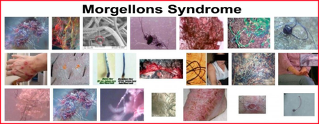 Morgellons