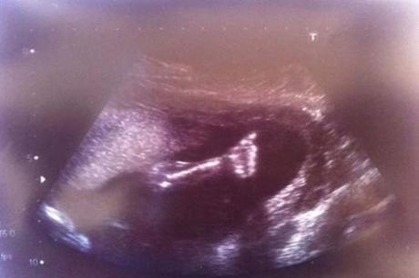 Baby’s thumbs-up saves her from being aborted