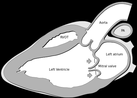 Friday Q&A: Mitral Valve Prolapse (MVP)