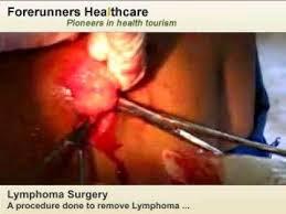 http://www.forerunnershealthcare.com/ar-lymphoma-surgery-india.html