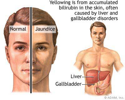 Mumps or Hepatitis, which one would you choose?