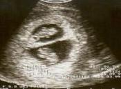 Conceiving Twins Natural