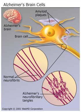 Alzheimer's brain cells