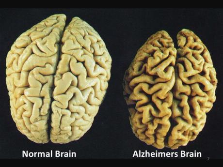 normal vs. Alzheimer's brain