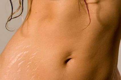 Reducing Stretch Marks