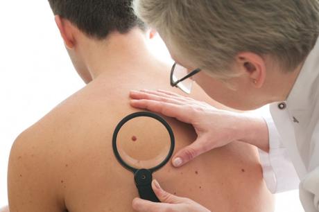 9 Facts everyone needs to know about skin cancer