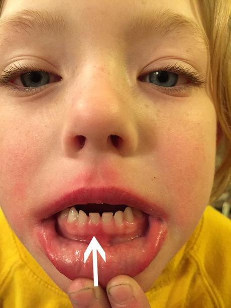 See this one looks like the big tooth is pushing up to get rid of the baby tooth. It is very swollen and looks very sore. This little girl is excited she might lose the tooth soon.
