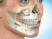 When Need Oral Maxillofacial Surgery?