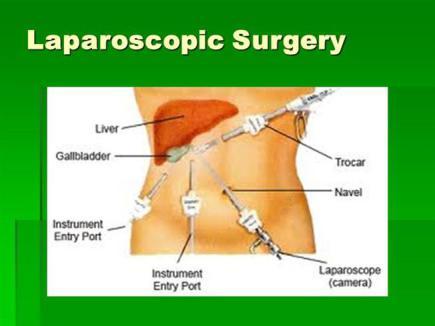 Laparoscopic Surgery