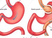 Laparoscopic Sleeve Gastrectomy: What Expect?