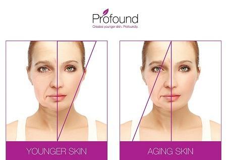 Profound creates younger skin profoundly