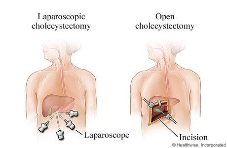 LAPAROSCOPIC Vs OPEN Surgery