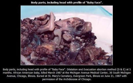 aborted baby's body parts
