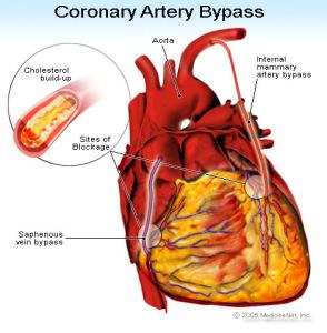 coronary_artery_bypass