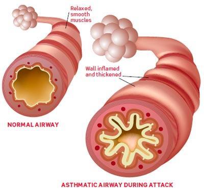 Top 5 effective herbs for bronchial asthma