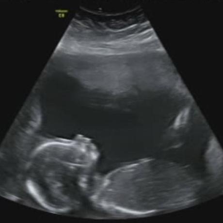 18 week scan. Profile of baby number 3. We don't know if it is a boy or a girl. We are going to have a surprise. 