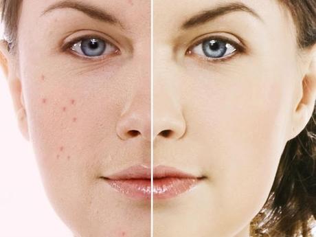 Facts about acne mechanica and scar treatment