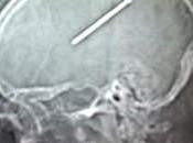 Fires Nail into Brain