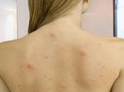 Back Acne; Best Acne Treatment Solution