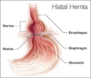 Hiatus Hernia – Causes, Symptoms & Ayurvedic Treatment