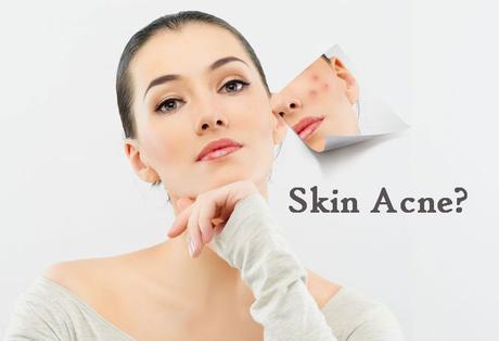 Aromatherapy acne treatment