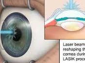 LASIK Surgery India Patient Testimonial