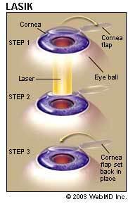 eye-health-LASEK-laser-eye-surgery_lasik