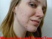 Best Ways Cure Prevent Teenage Acne