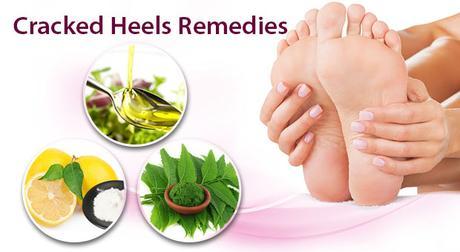 Home Remedies For Cracked Heels