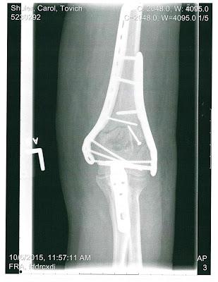 X-rays of my wife's shattered arm provide dramatic evidence of the trauma rogue cops can leave behind