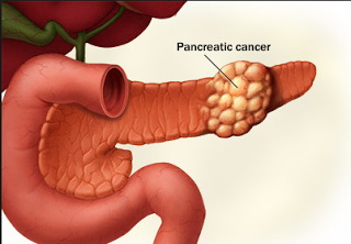 FDA approves new treatment for advanced pancreatic cancer