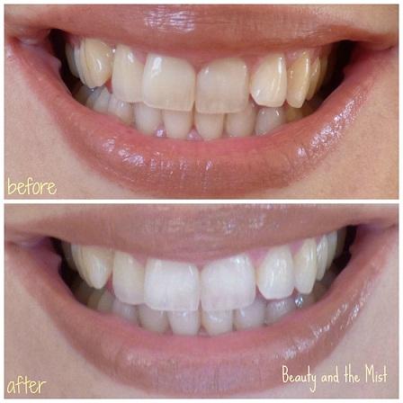 Smile Brilliant Whitening Kit Review and Discount Code