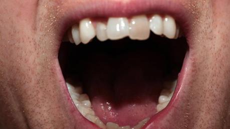 Footballers and Olympic Athletes Have Bad Teeth – Here’s Why
