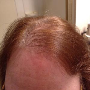 Hair Loss? Enter In RevivHair Stimulating Serum