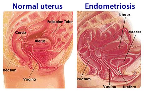 Endometriosis Herbal Treatment and Lifestyle Changes