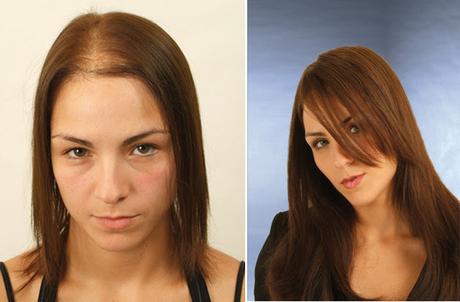 Before and After Laser hair Treatment