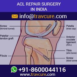 Affordable ACL Repair Surgery in India