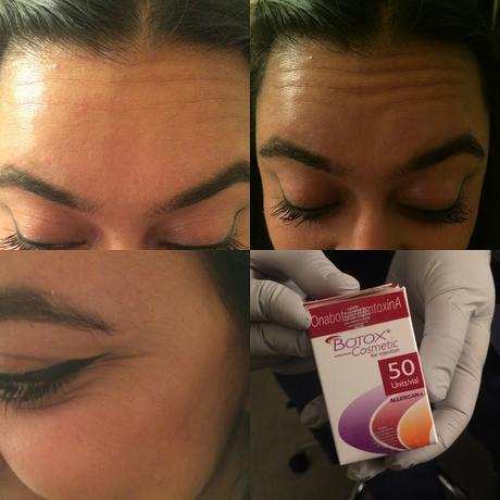 Back To Basics: Why I Choose To Get Botox in my 30's
