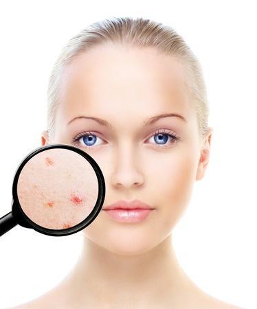 Causes For Cystic Acne