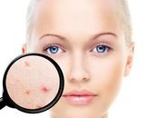 Effective Home Remedies Cystic Acne