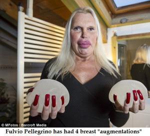 Fulvio Pellegrino had 4 breast implants
