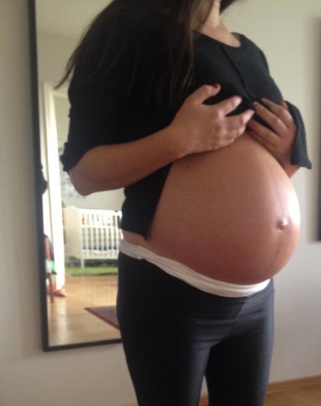 Can I prevent stretch marks?