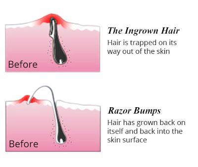 How to Get Rid of Ingrown Hair and Razor Bumps. Difference Between Ingrown Hair and Razor Bumps