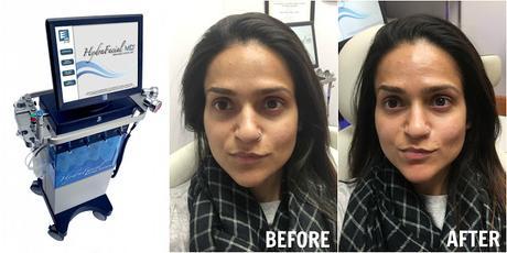 Review: HydraFacial MD Review: HydraFacial MD