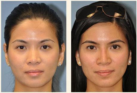 Cosmetic Procedures without Going under the Knife