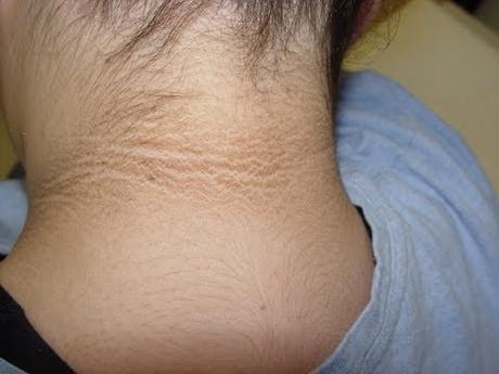 Dark neck skin causes