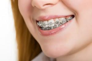 Does Your child need braces?