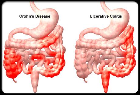 Alternative treatment for ulcerative colitis – Top 4 Herbs