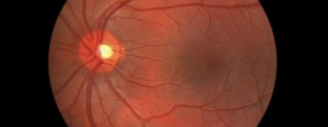 Can Diabetes Complications Be Reversed?