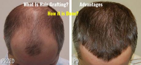 Hair Grafting Method Advantages